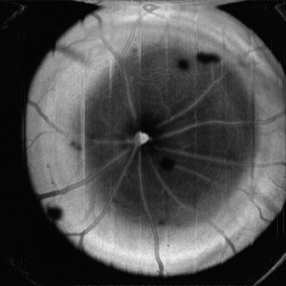 B-scan example vascular map