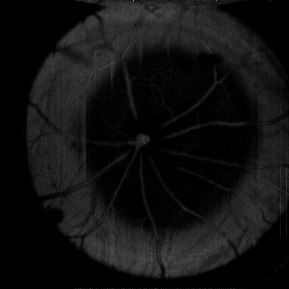 Real OMAG example vascular map